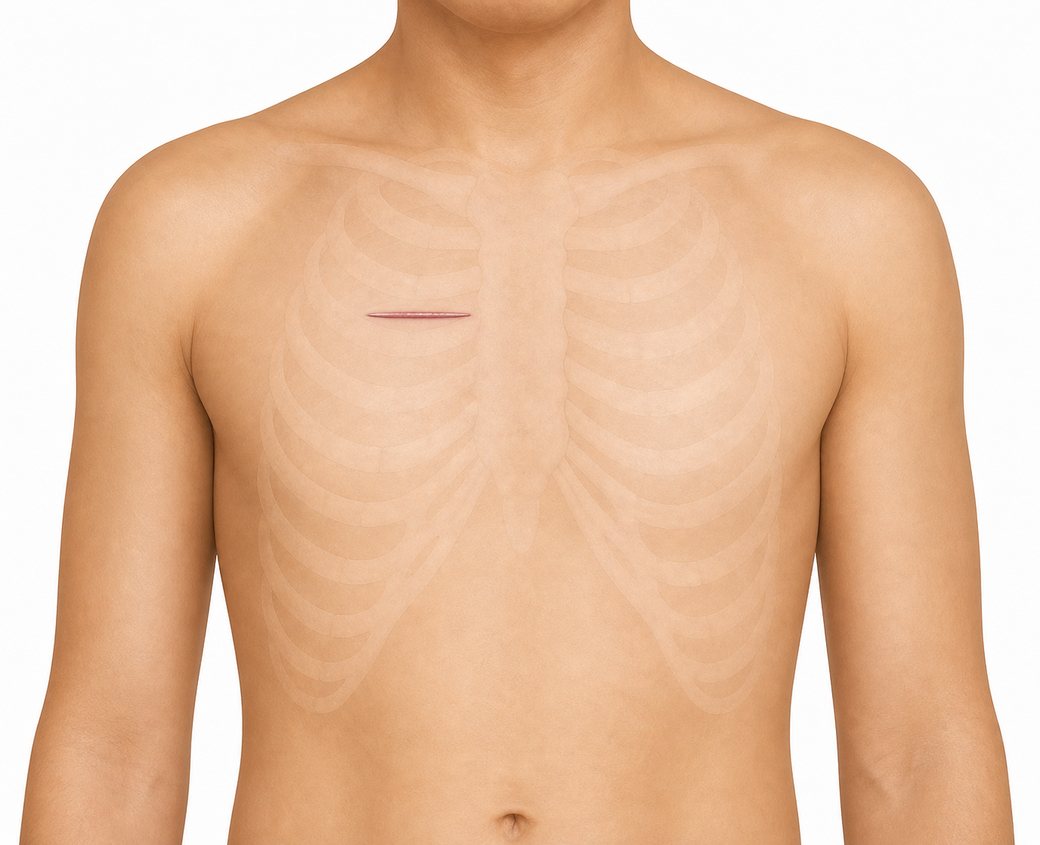 Small anterior right-thoracotomy incision beside the sternum