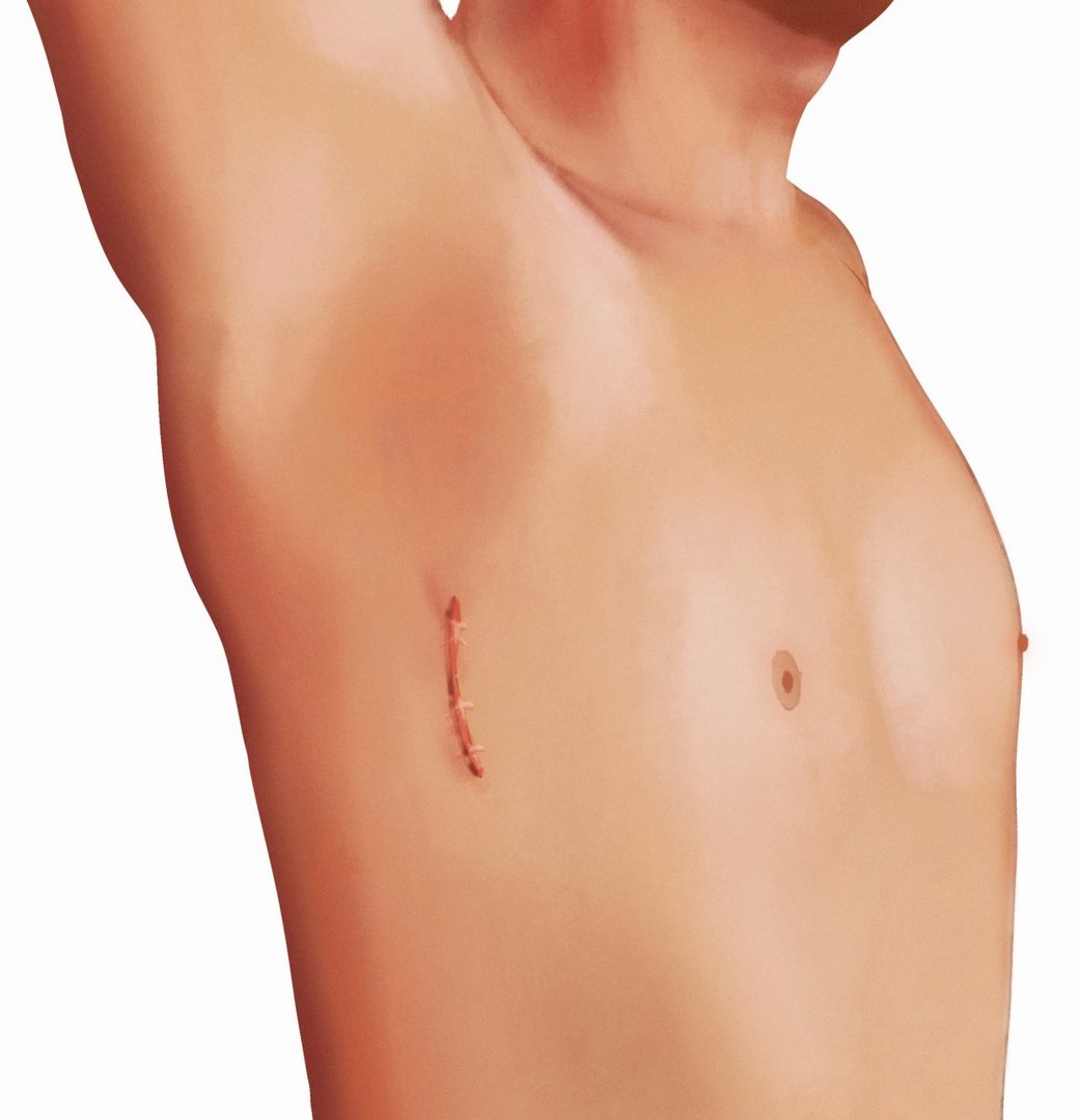Healed trans-axillary incision, hidden beneath the arm